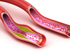 Arterioskleroza – kogo dotyczy zwiększone ryzyko choroby? Tętnice z miażdżycą