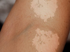 Jak wygląda łupież pstry? Jak go leczyć? Łupież pstry